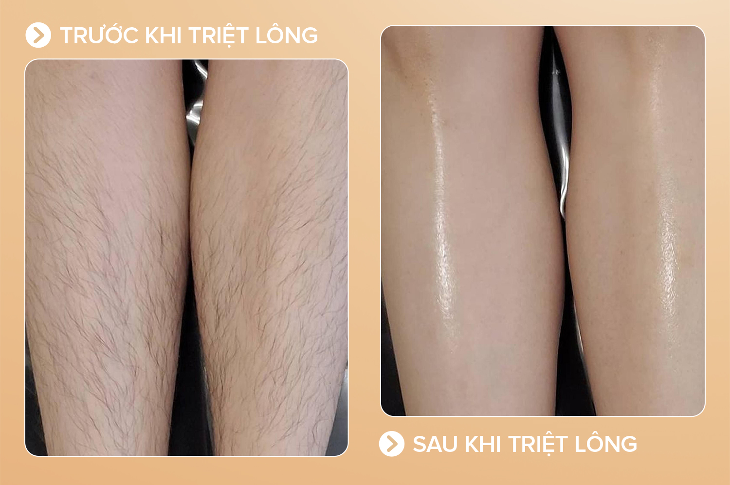 Hiệu quả sau khi triệt lông chân