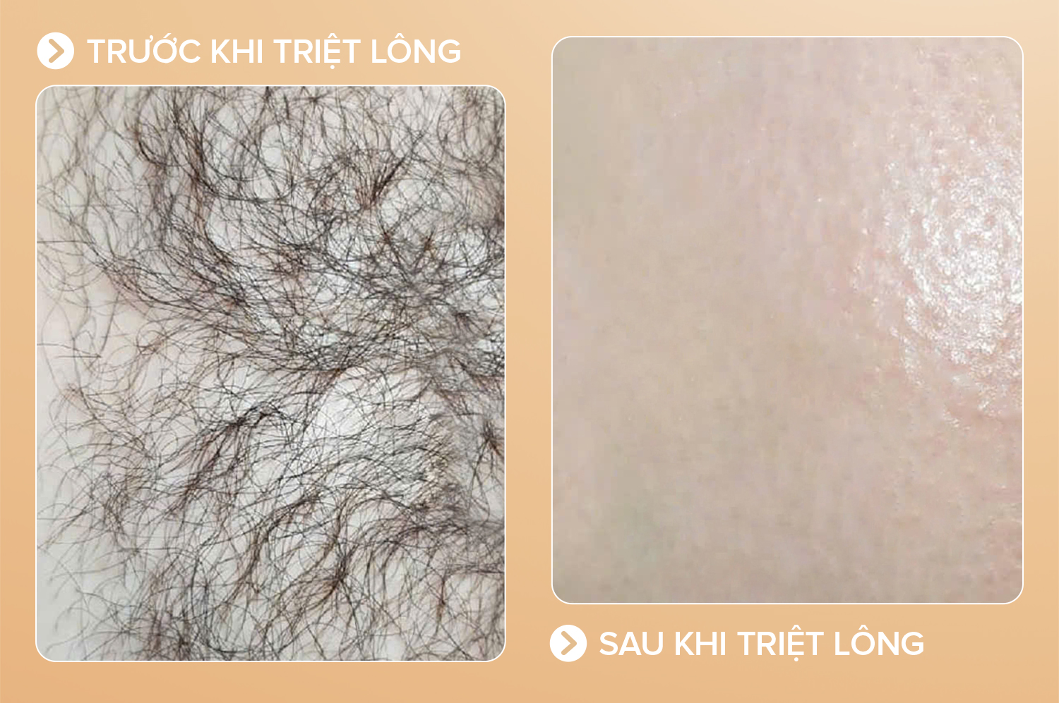 Triệt lông bikini