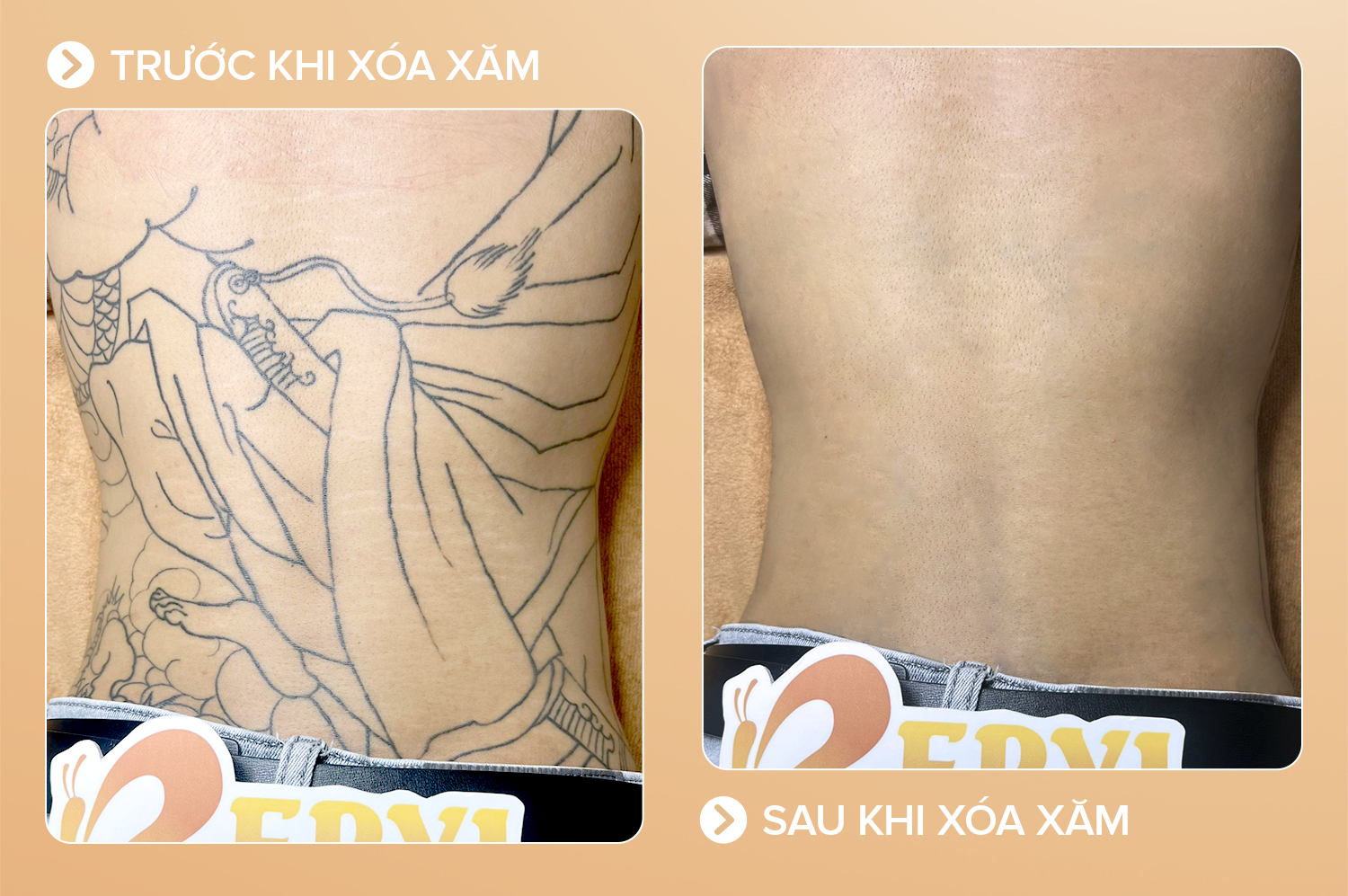 Xoá hình xăm lớn