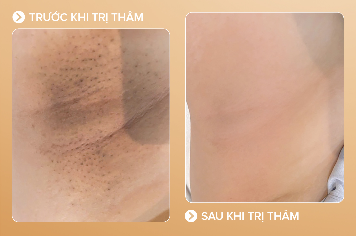 Thâm do viêm nang lông - 10 buổi - cải thiện 90%