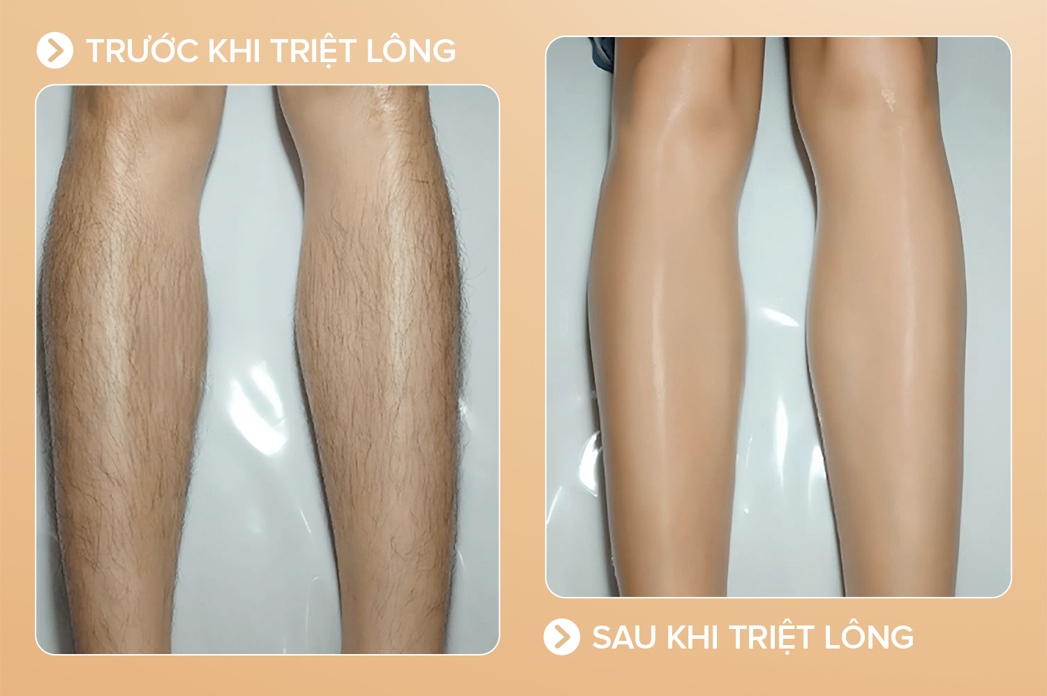 Hiệu quả sau khi triệt lông chân