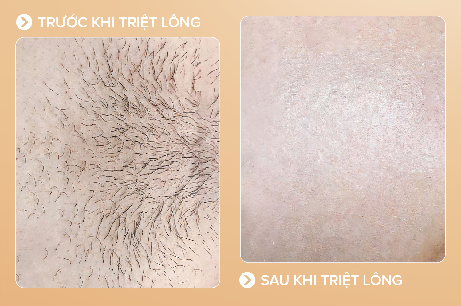 Triệt lông bikini