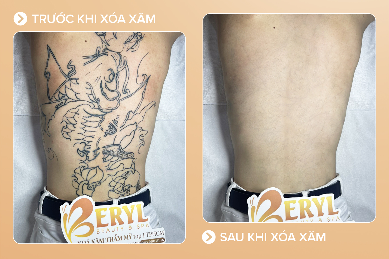 Xoá hình xăm lớn
