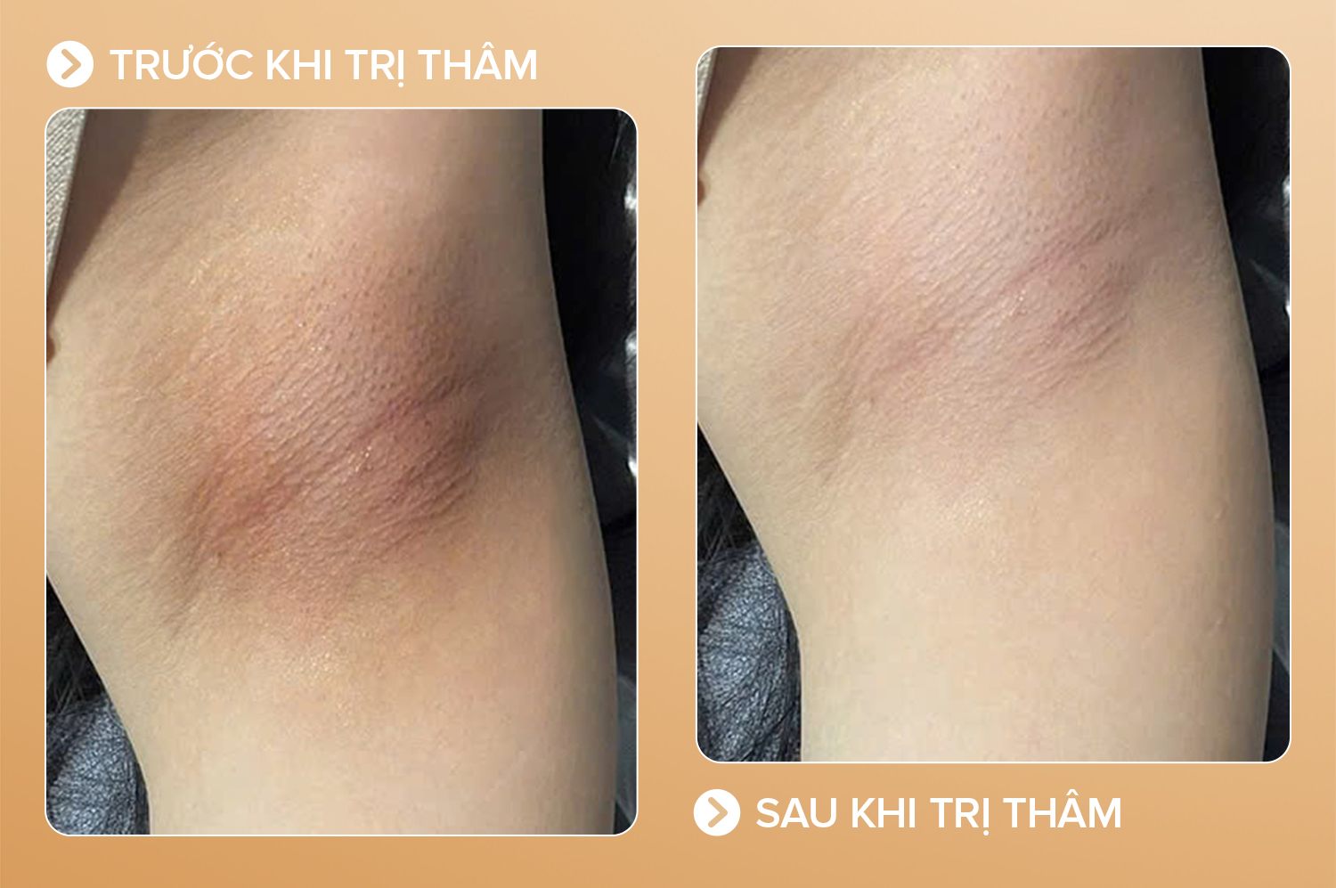 Thâm do cao nhổ - 5 buổi - cải thiện 100%