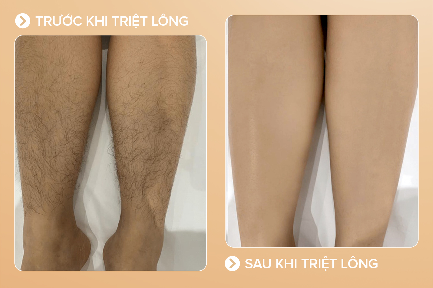 Hiệu quả sau khi triệt lông chân