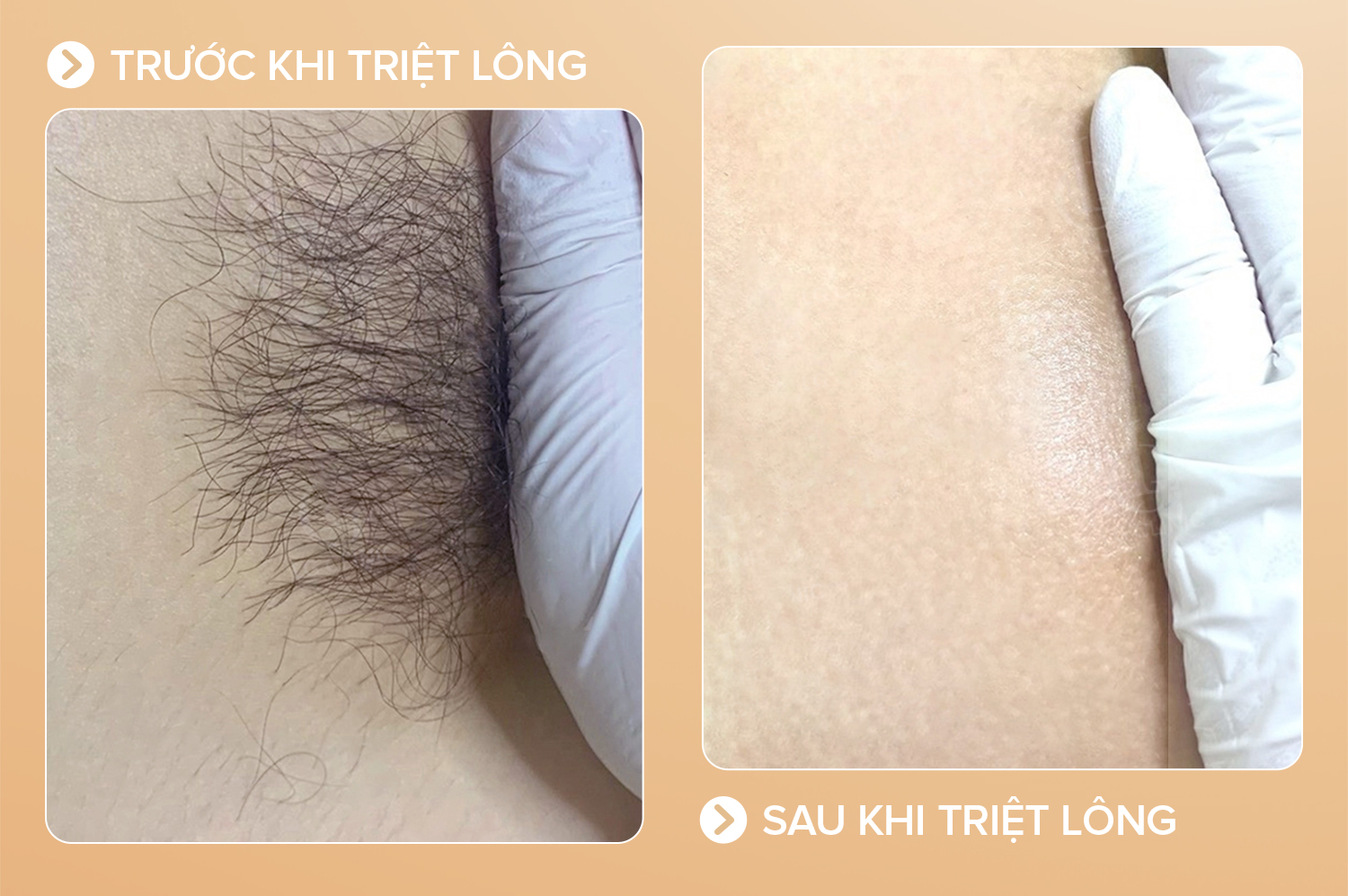 Triệt lông bikini