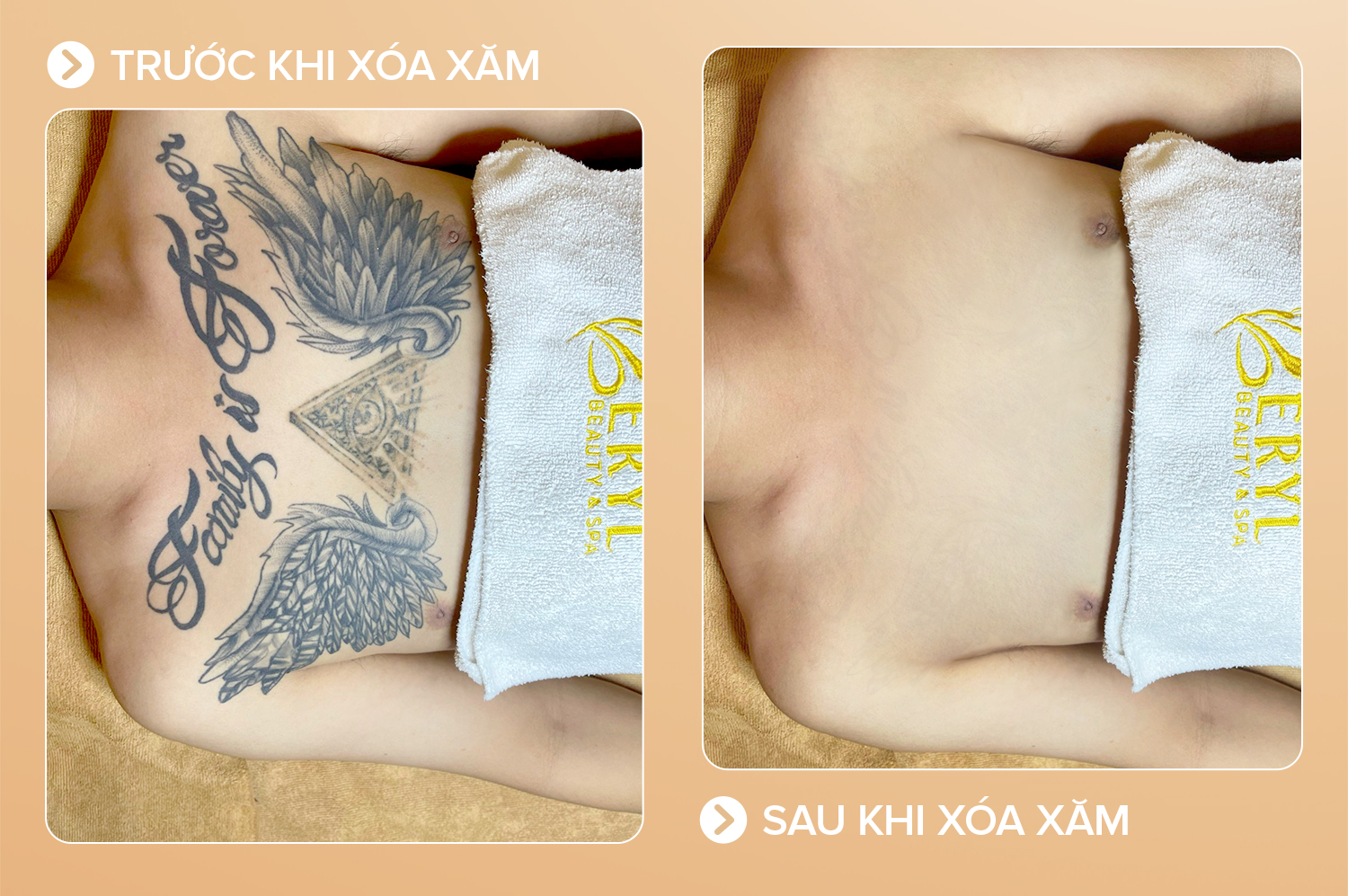 Xoá hình xăm lớn
