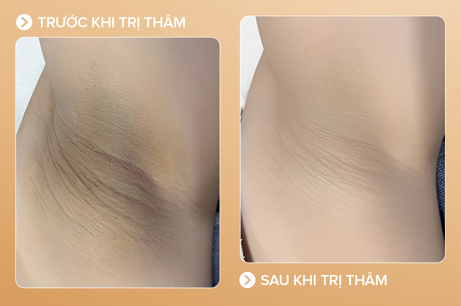 Thâm sau sinh - 10 buổi - cải thiện 96%