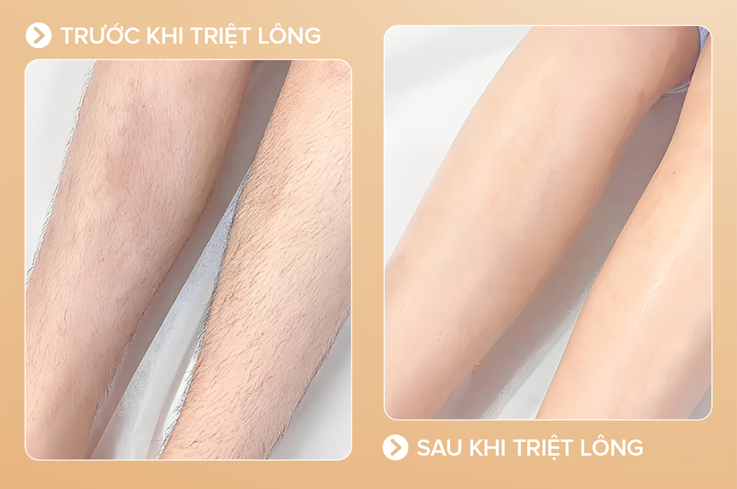 Hiệu quả sau khi triệt lông chân