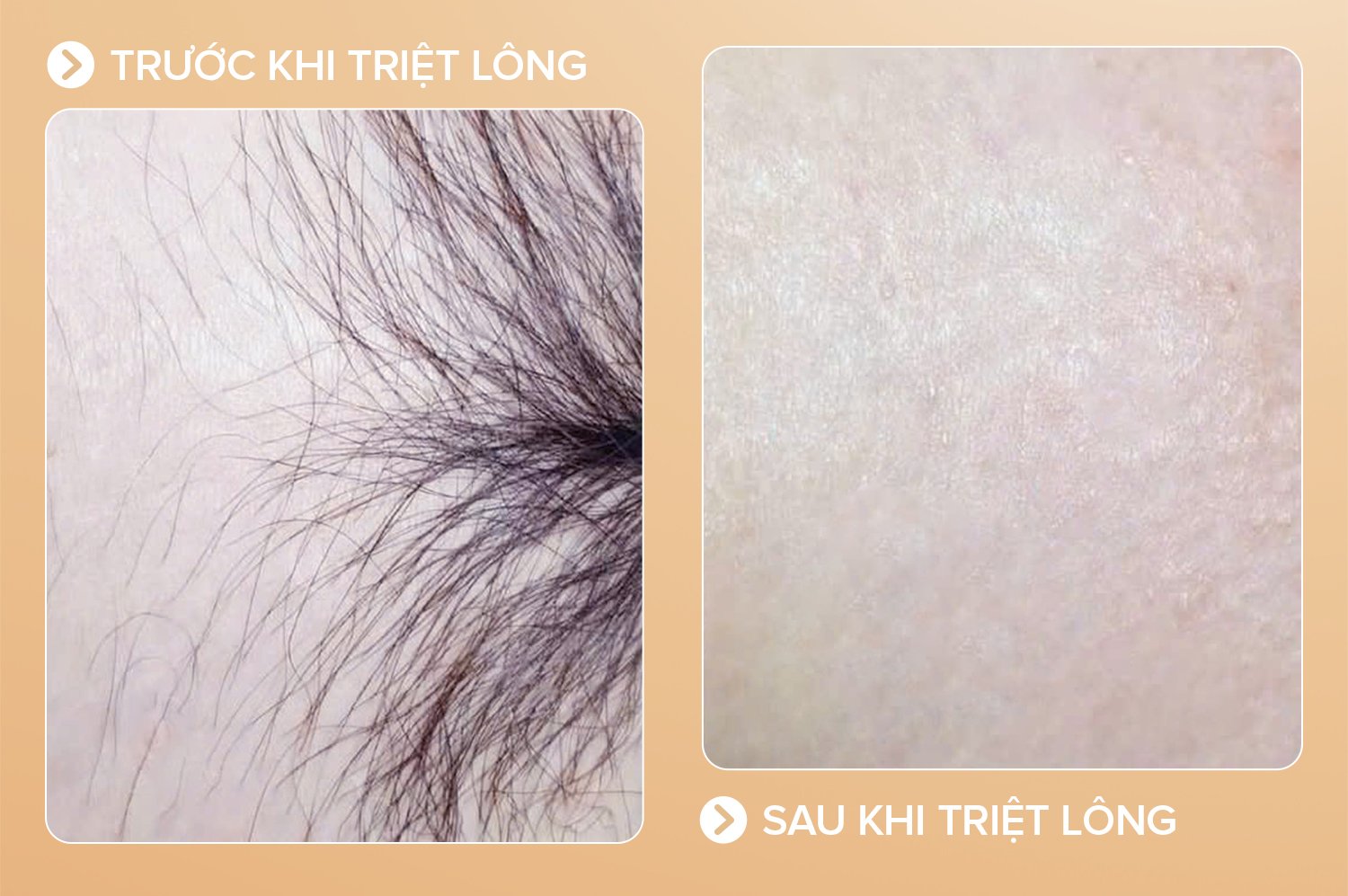 Triệt lông bikini