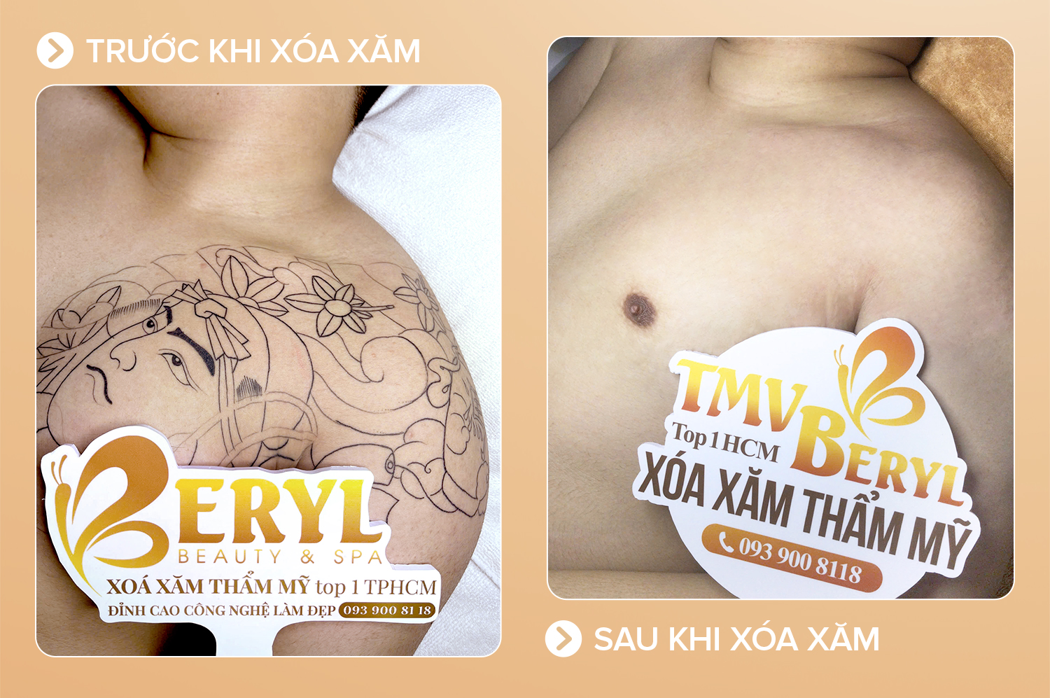 Xoá hình xăm lớn
