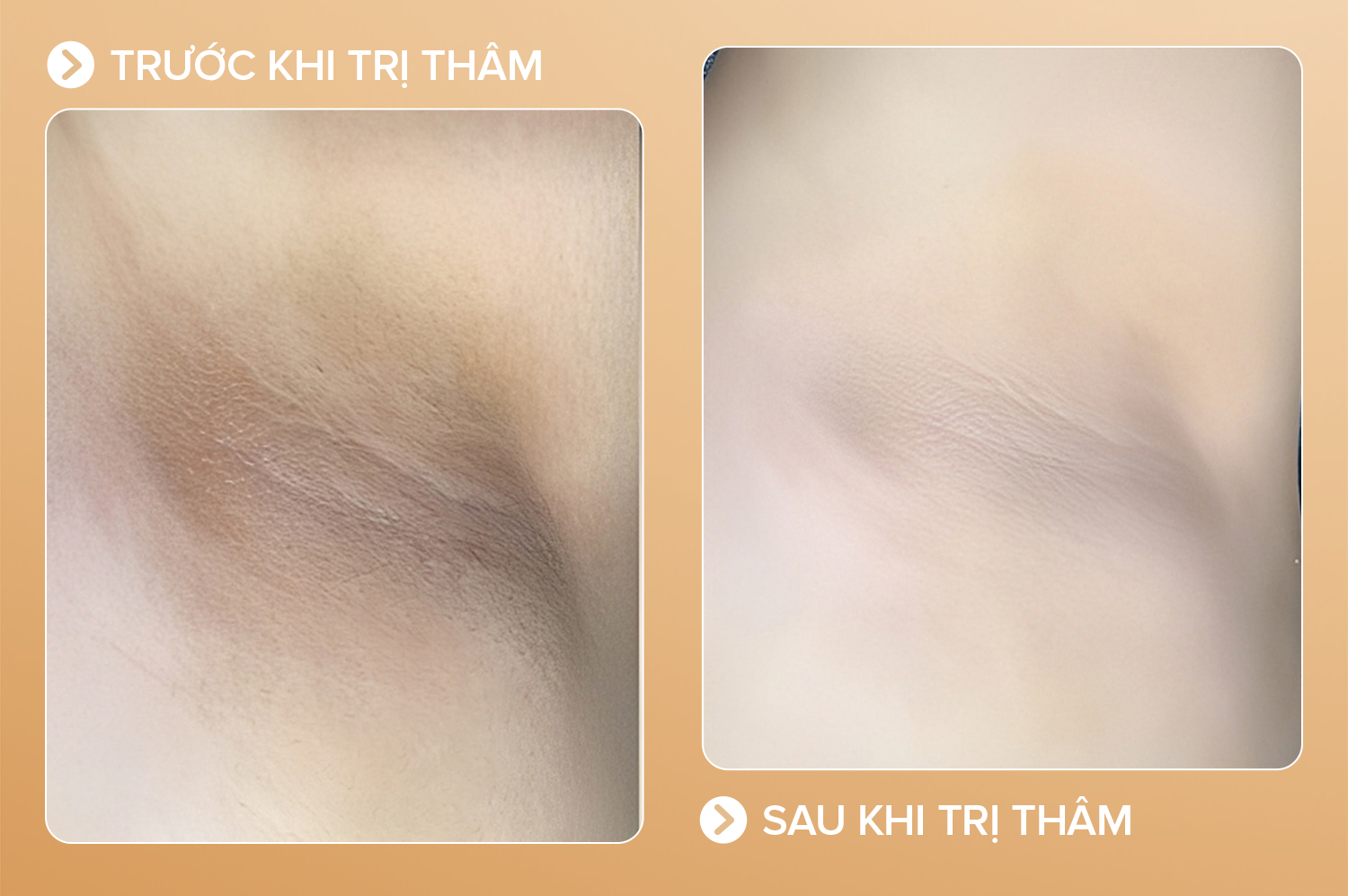 Thâm do cơ địa - 7 buổi - cải thiện 90%