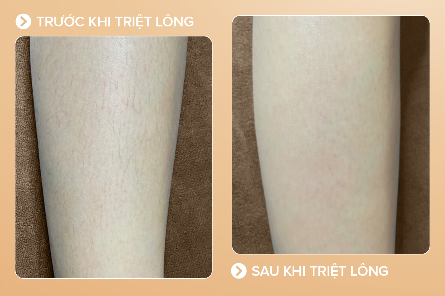 Hiệu quả sau khi triệt lông chân