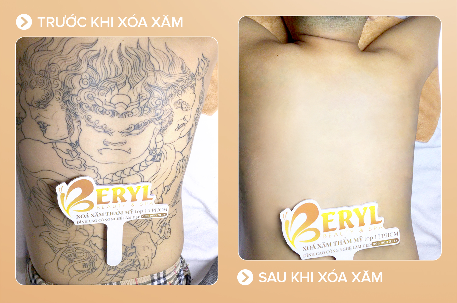 Xoá hình xăm lớn