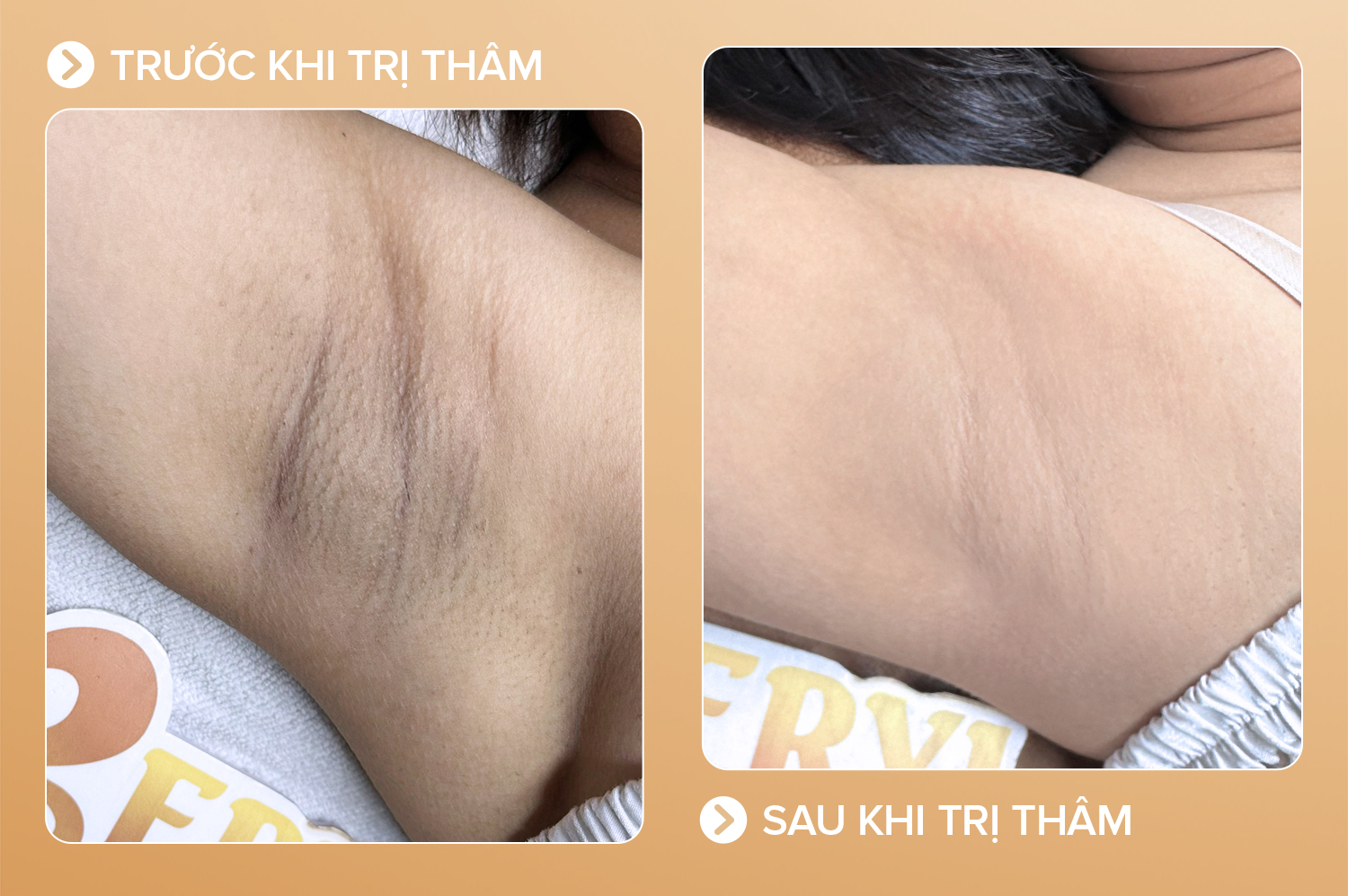Thâm sần – 5 buổi – cải thiện 95%