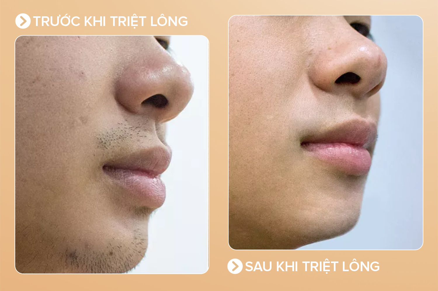 Triệt lông cho nam