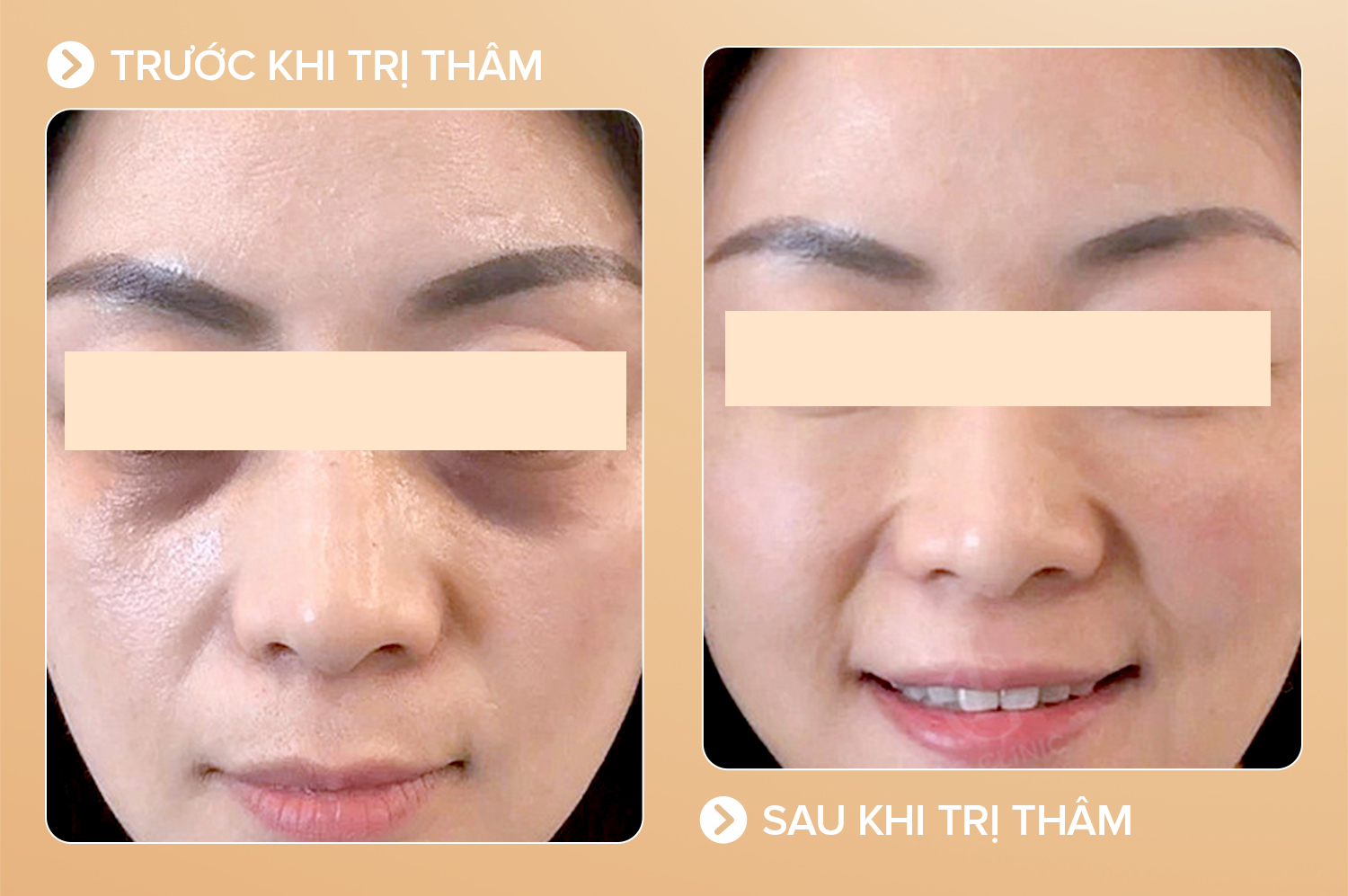 Trị thâm mắt