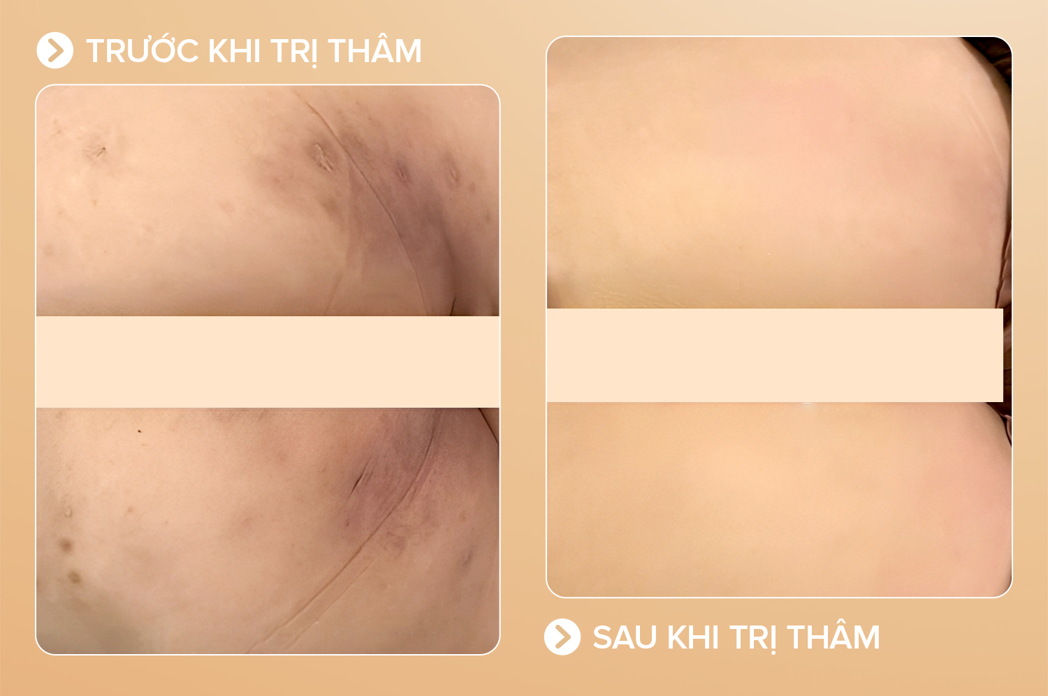trị thâm mông