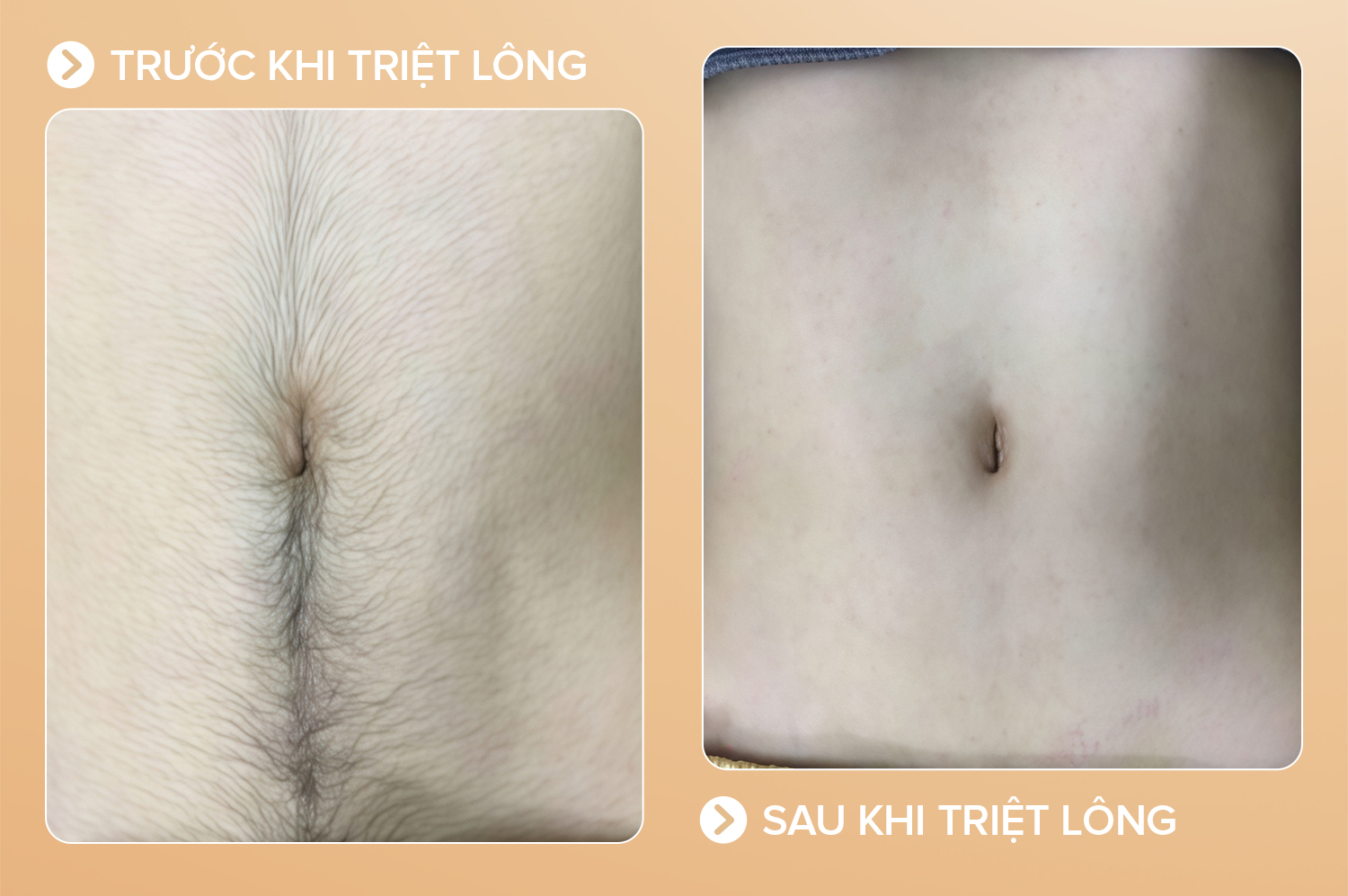 Triệt lông toàn thân