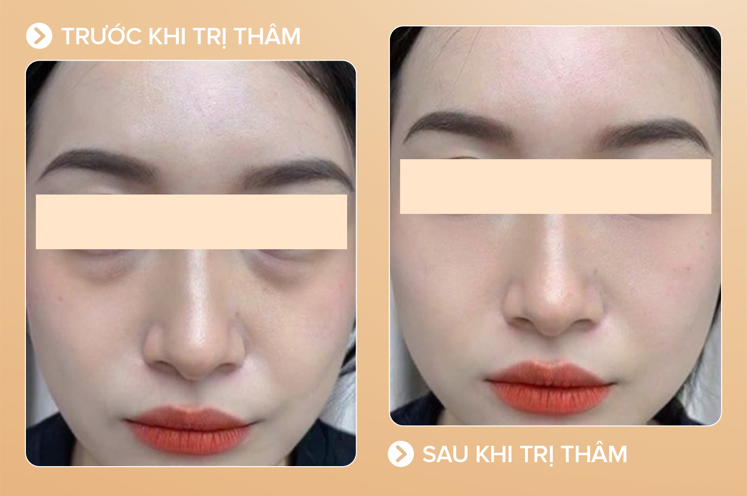 Trị thâm mắt