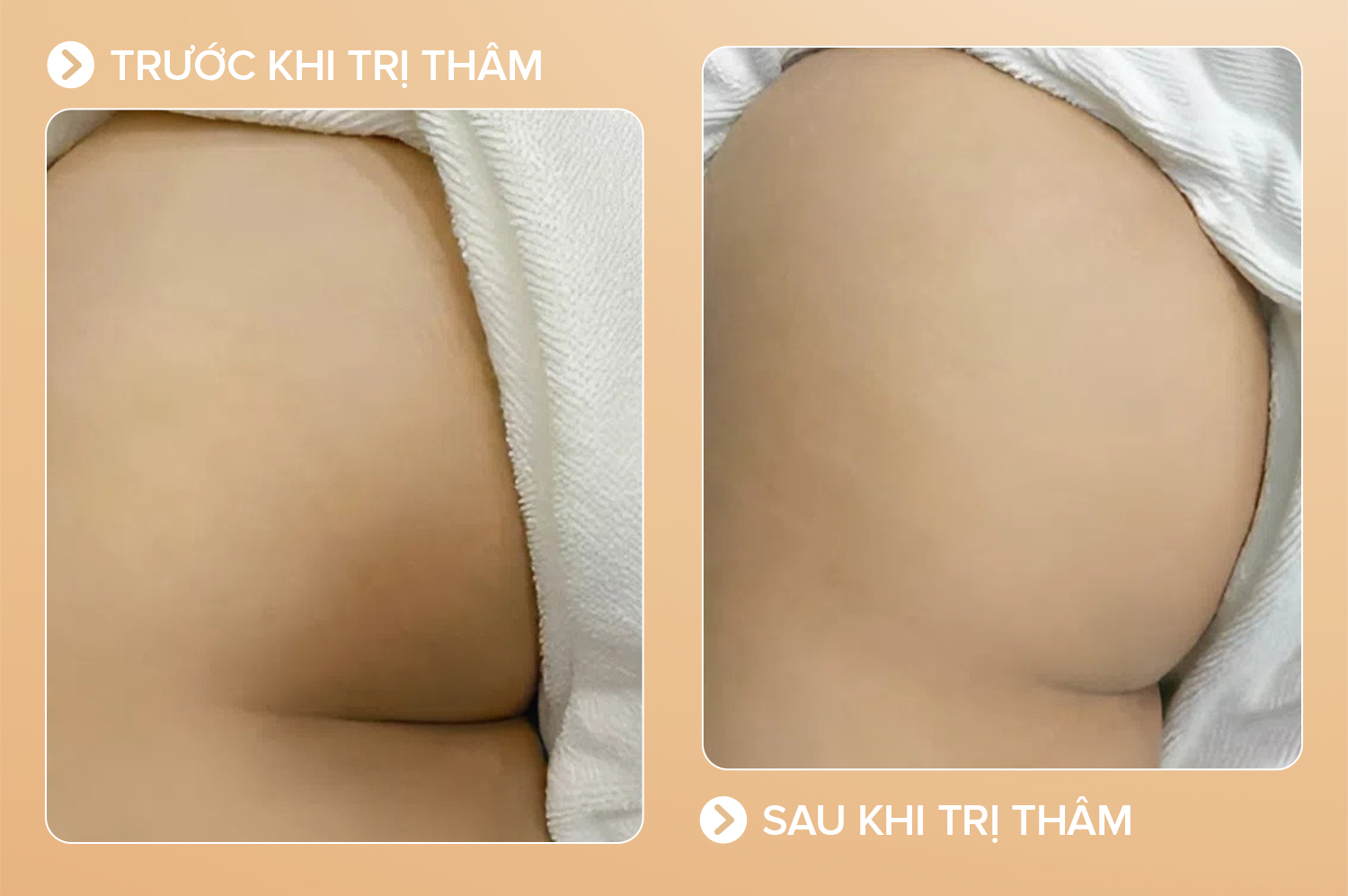 trị thâm mông