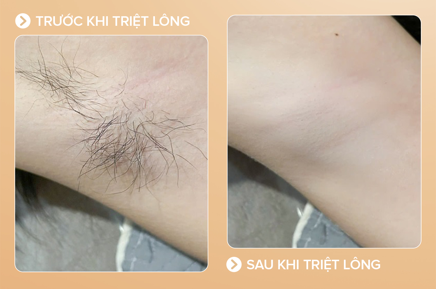 Triệt lông toàn thân