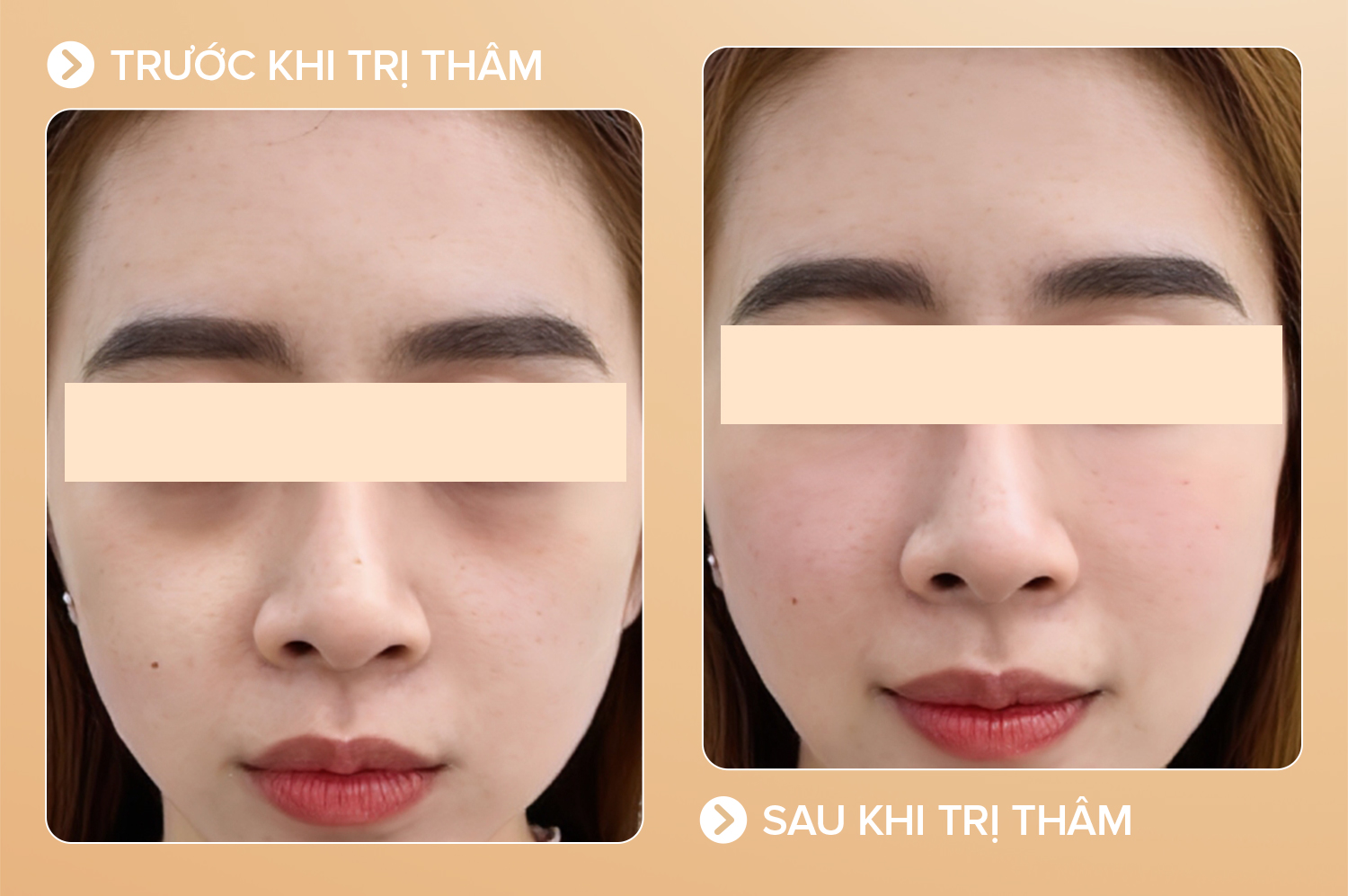 Trị thâm mắt