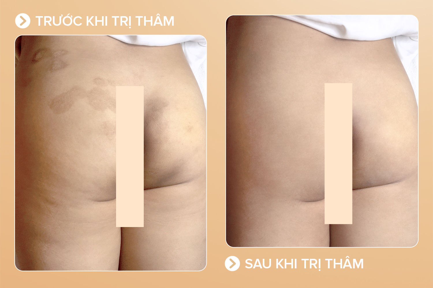 trị thâm mông