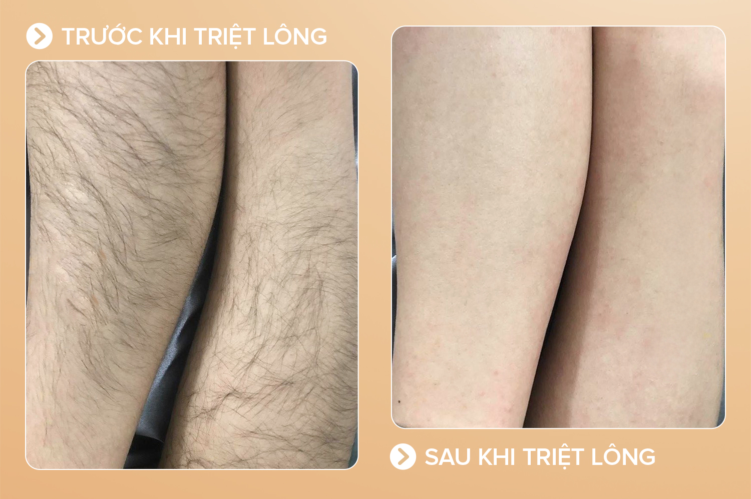 Triệt lông toàn thân