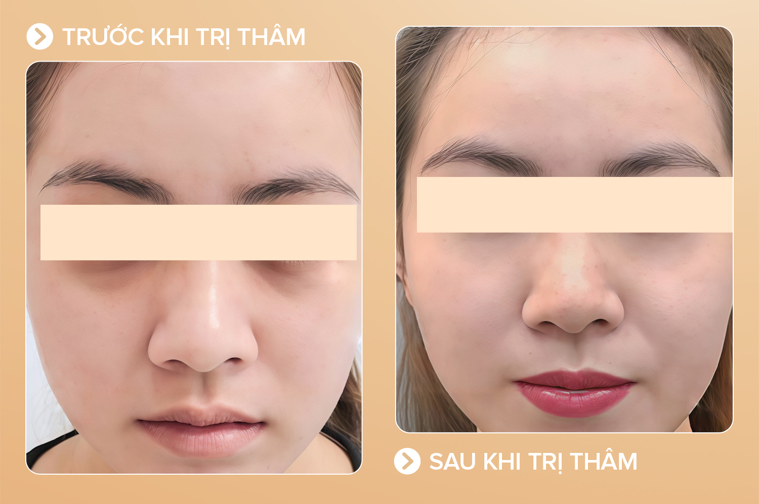 Trị thâm mắt