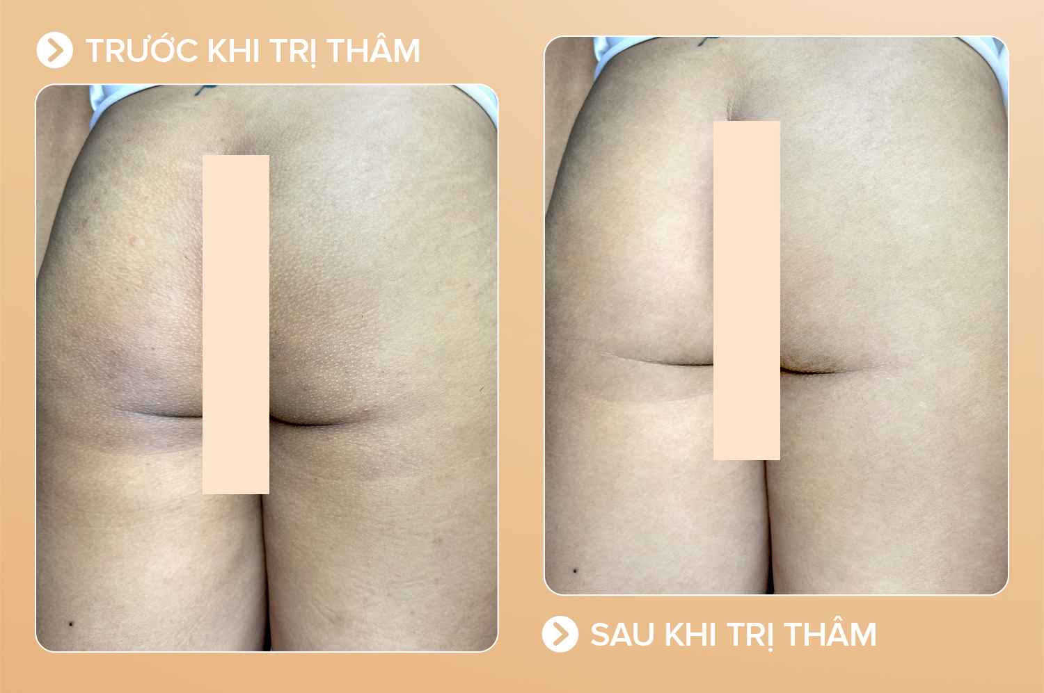 trị thâm mông