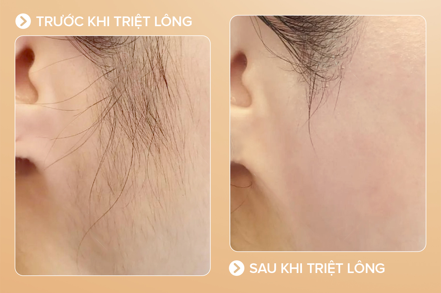 Triệt lông toàn thân