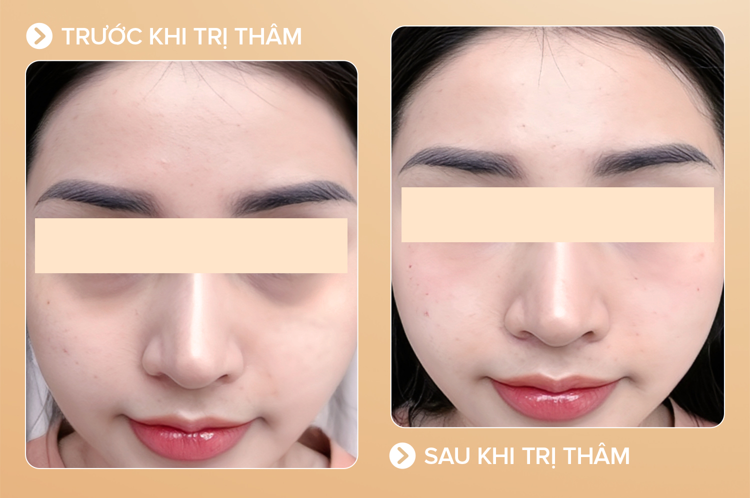 Trị thâm mắt