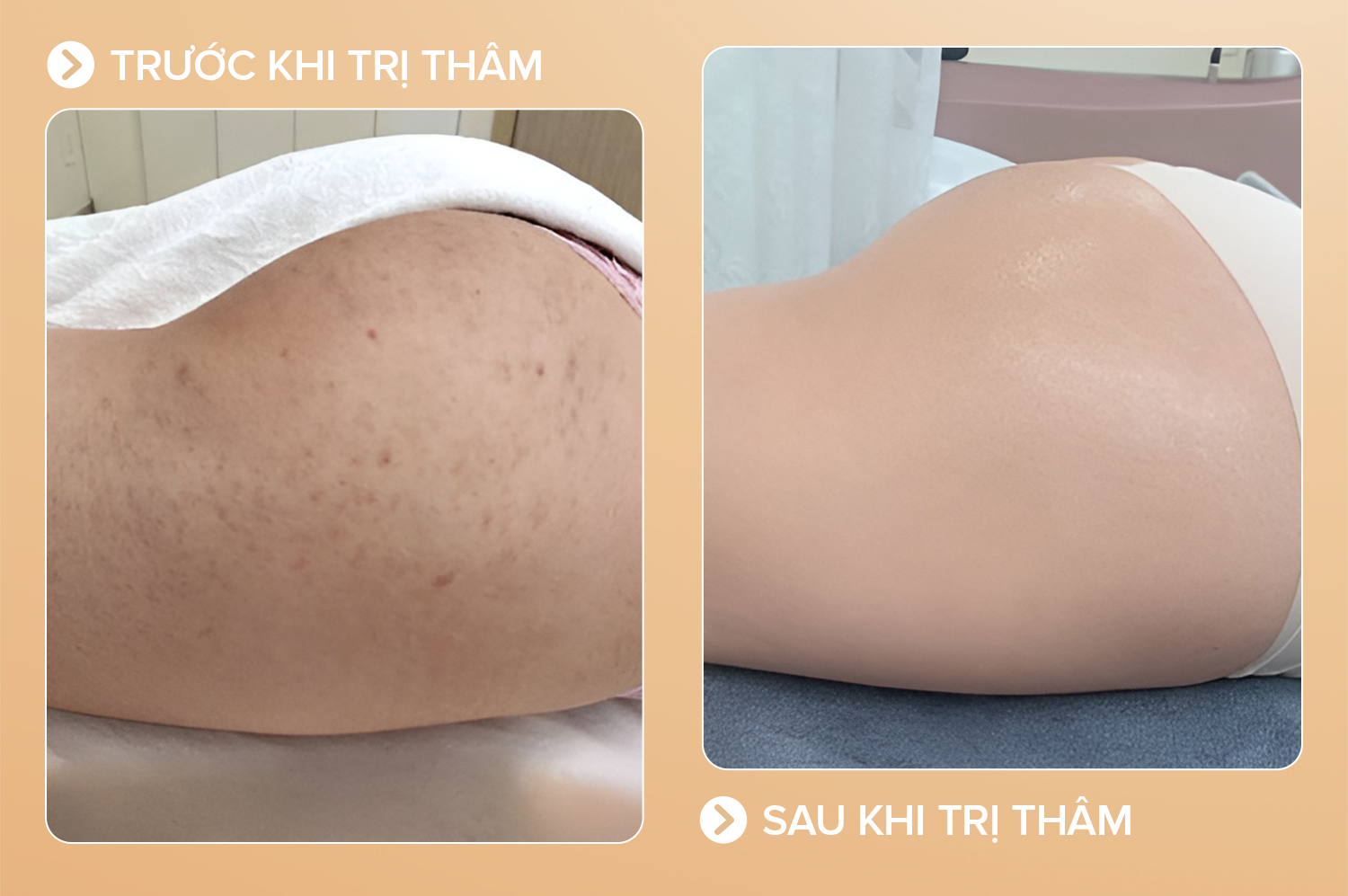 trị thâm mông