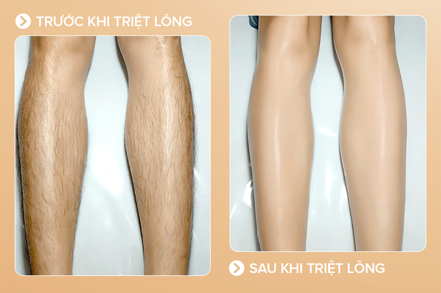 Triệt lông toàn thân