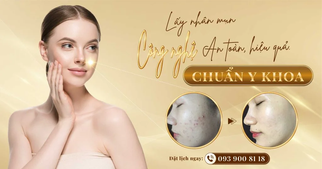 Lấy nhân mụn