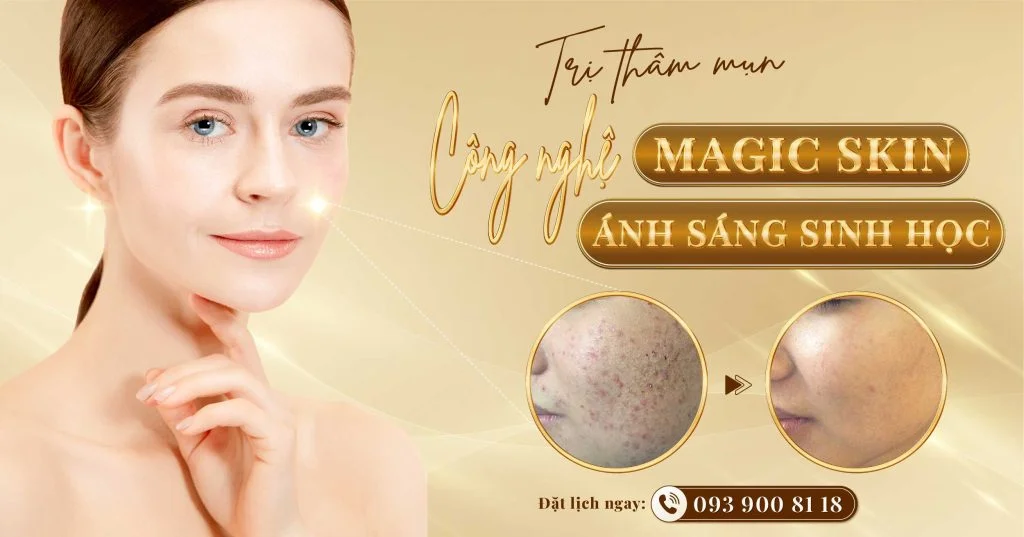 trị thâm mụn