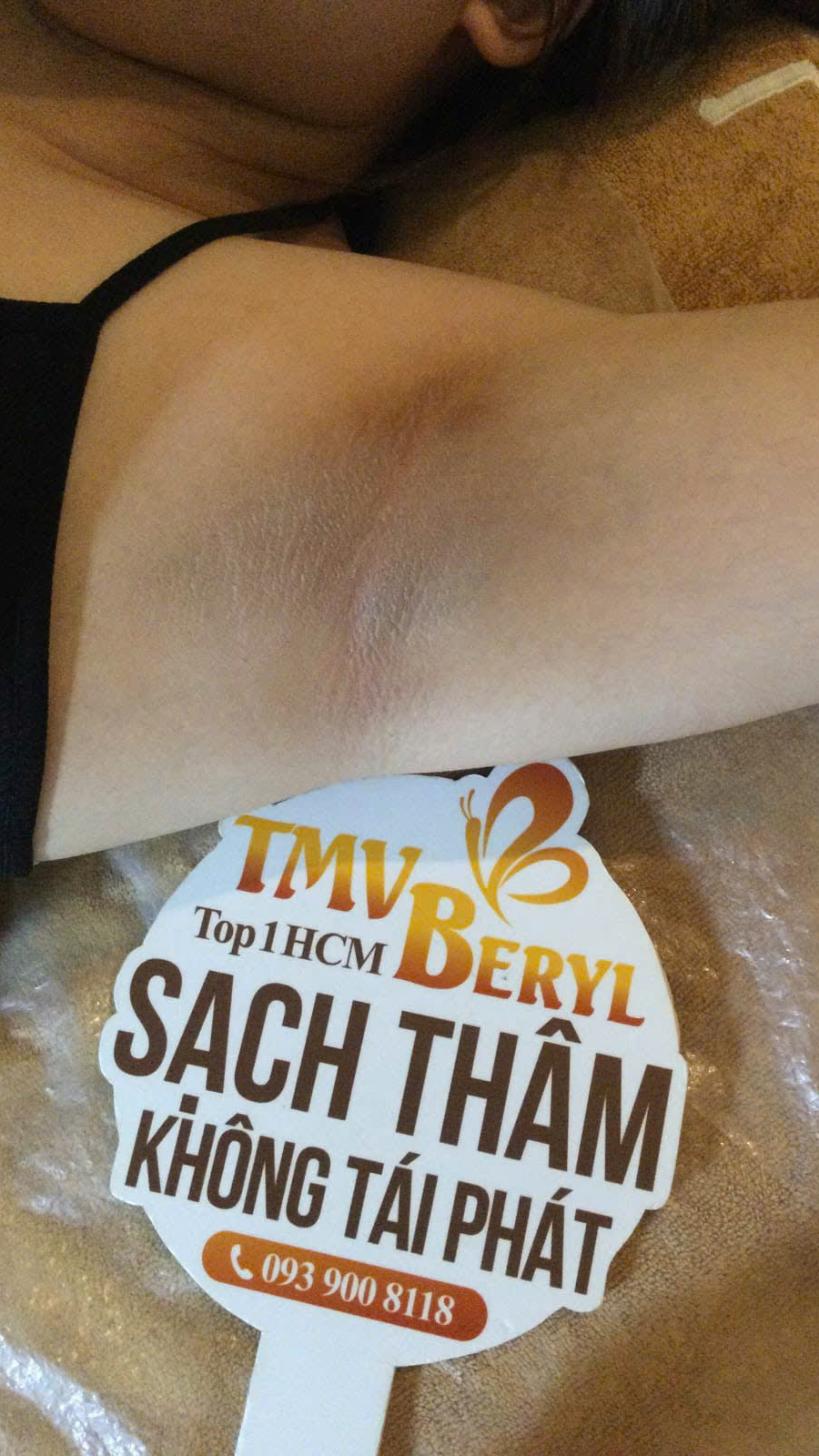 Nách bị thâm do cạo nhiều lần