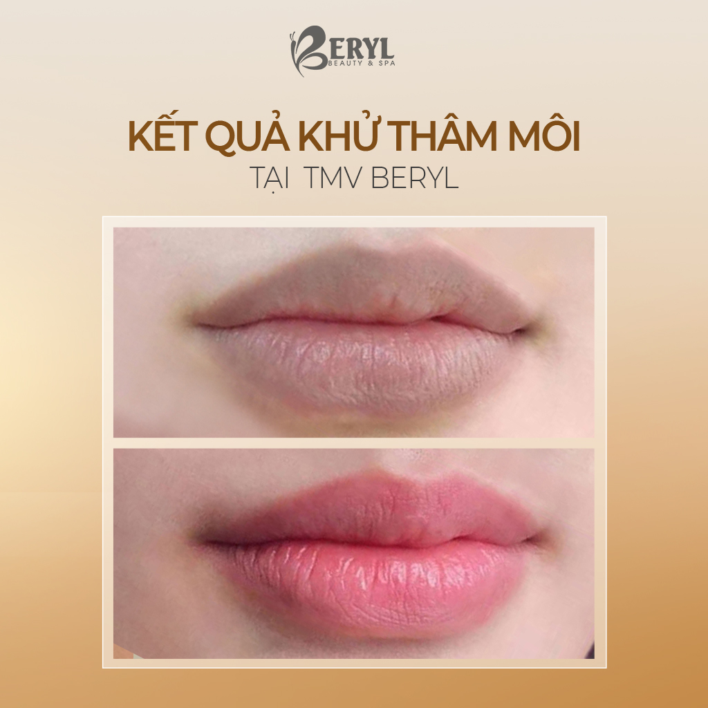 Kết quả khử thâm môi