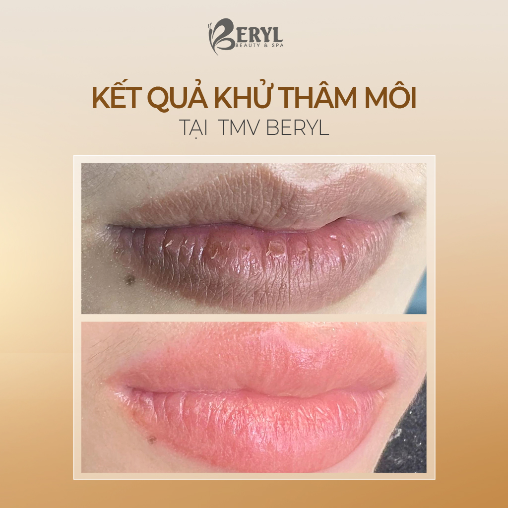Kết quả khử thâm môi